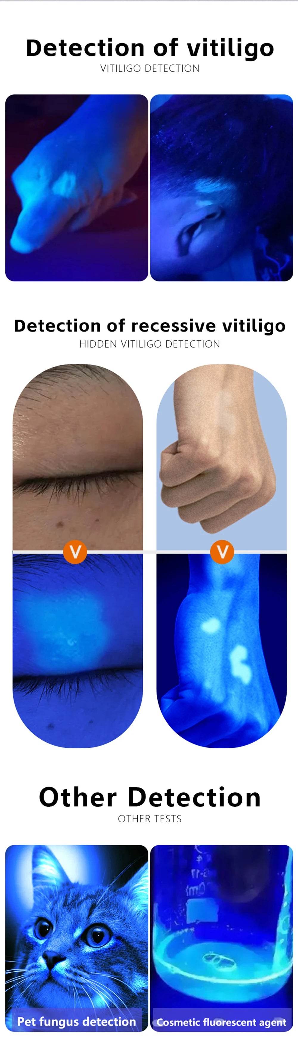 NEW DW-B200 Woods Lamp Skin Analyzer – 365nm UV LED Magnifier for Vitiligo, Acne &amp; Psoriasis Detection | Handheld UV Skin Inspection Tool with 1.5x Magnification &amp; Rechargeable Battery - One-Sake.com